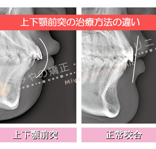 口ゴボ・上下顎前突の治療方法の違い