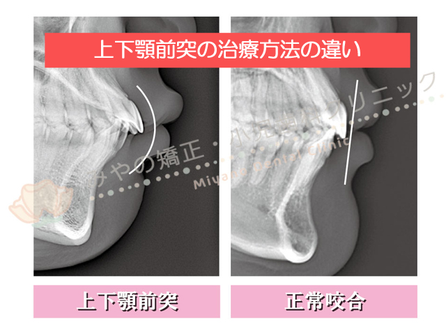 口ゴボ・上下顎前突の治療方法の違い