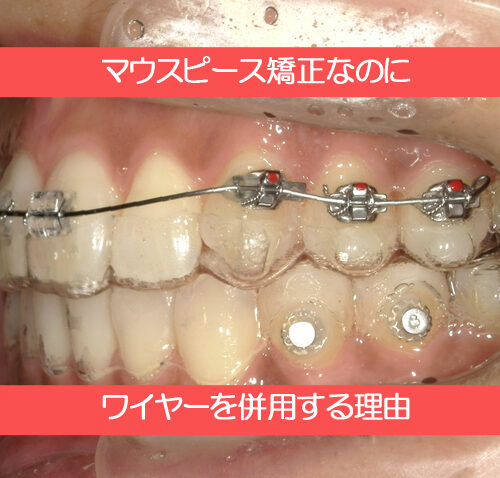 マウスピース矯正なのにワイヤー矯正を併用する理由