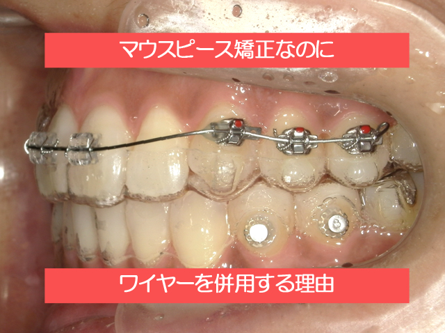 マウスピース矯正なのにワイヤー矯正を併用する理由