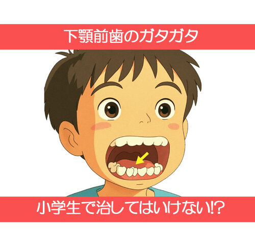 下顎前歯のガタガタは小学生で治してはいけない！？