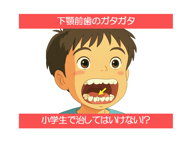 下顎前歯のガタガタは小学生で治してはいけない！？