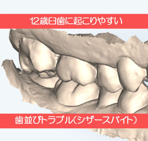 12歳臼歯に起こりやすい歯並びのトラブル