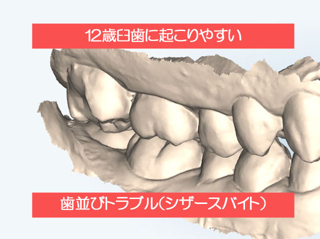 12歳臼歯に起こりやすい歯並びのトラブル