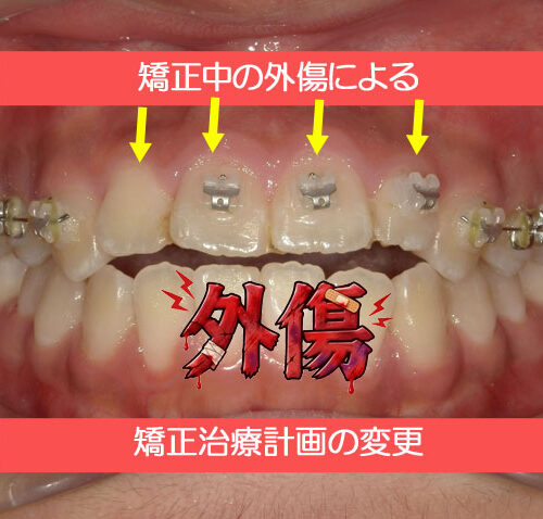 矯正中の外傷による矯正治療計画の変更