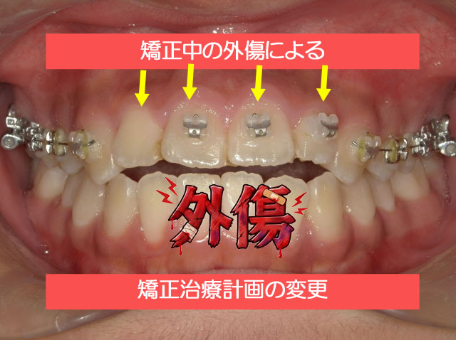 矯正中の外傷による矯正治療計画の変更