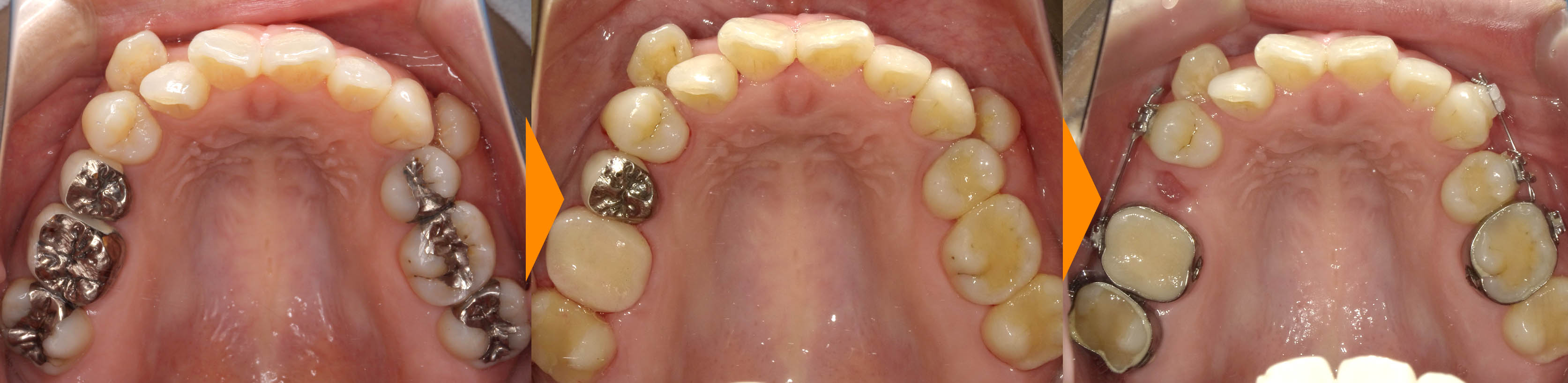 矯正前・矯正中のむし歯治療②