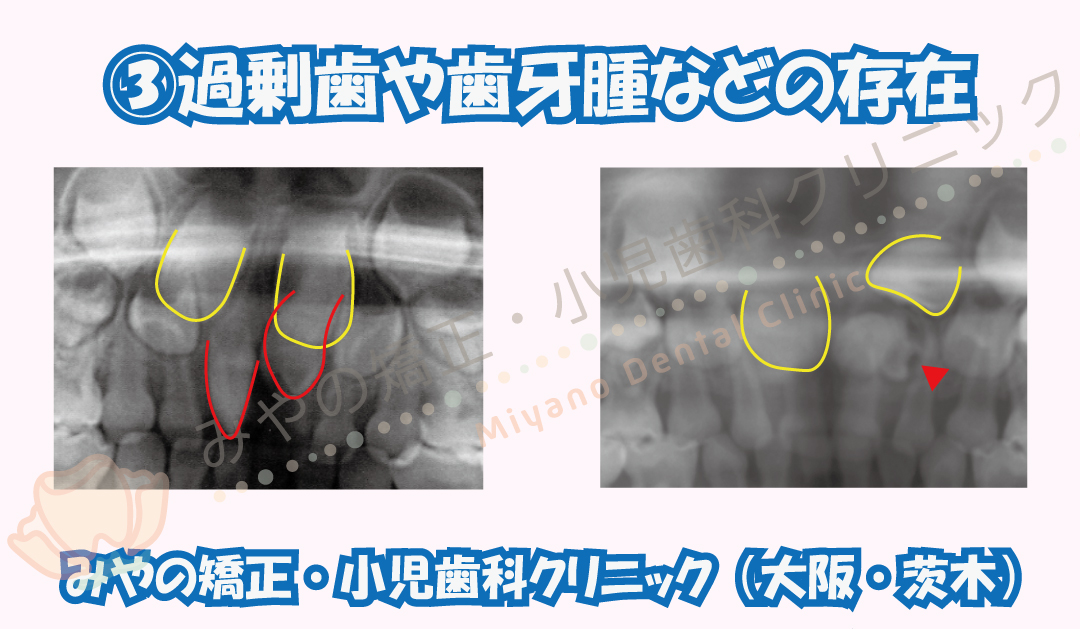 ③過剰歯や歯牙腫などの存在