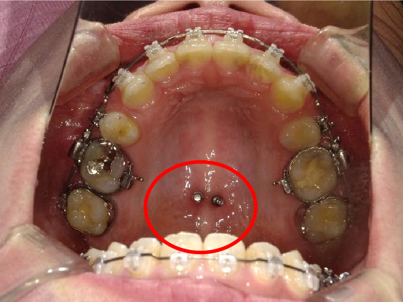 ①歯科矯正用アンカースクリュー
