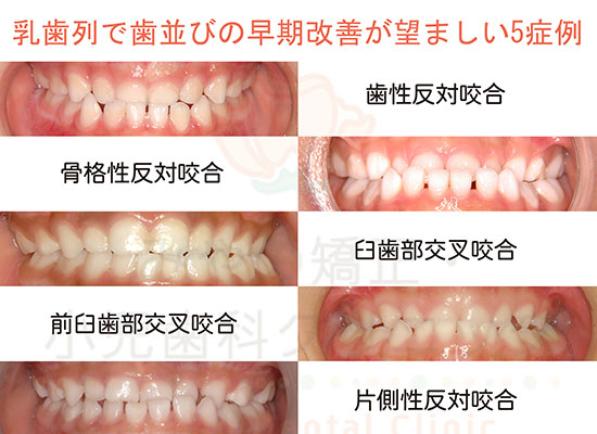 乳歯列で特に改善が必要な5症例