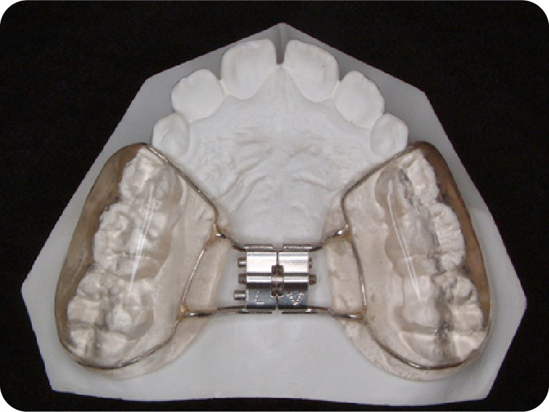 上顎急速拡大装置