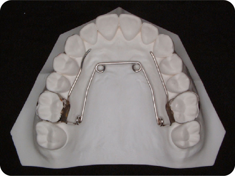 上顎歯列拡大装置クワドヘリックス