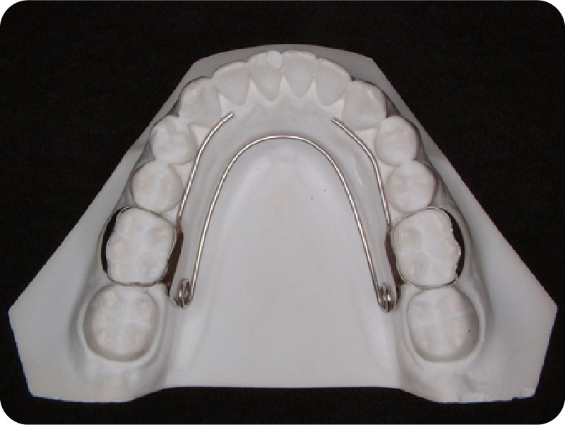 下顎歯列拡大装置バイヘリックス