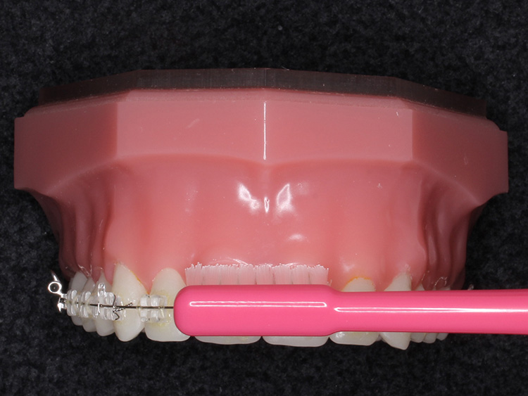 ②矯正中の歯ブラシの当て方の指導