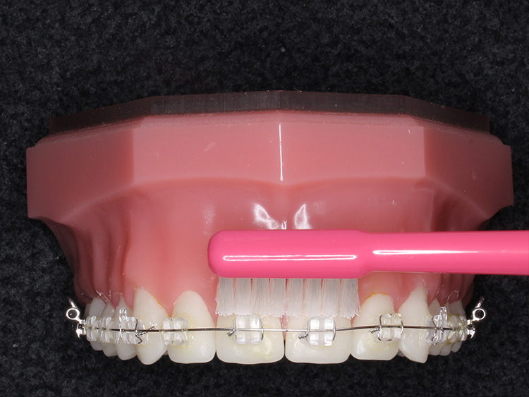 ②矯正中の歯ブラシの当て方の指導