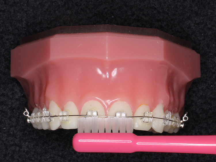 ②矯正中の歯ブラシの当て方の指導