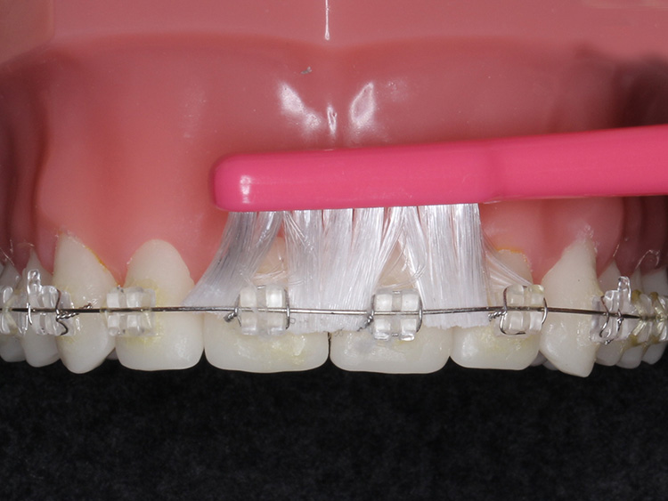 ②矯正中の歯ブラシの当て方の指導