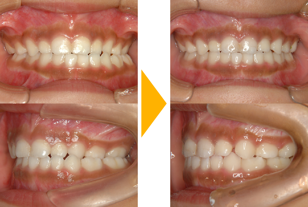 症例3：臼歯部交叉咬合(顎をずらして噛む)の改善