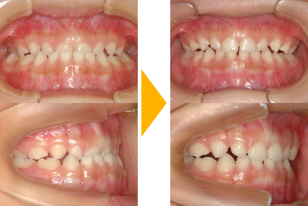 症例4：前臼歯部交叉咬合(受け口・顎をずらして噛む)の改善