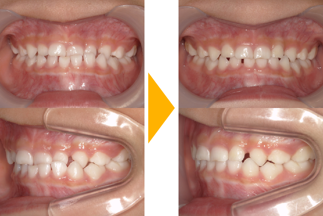 症例5：片側性反対咬合(受け口・顎をずらして噛む)の改善