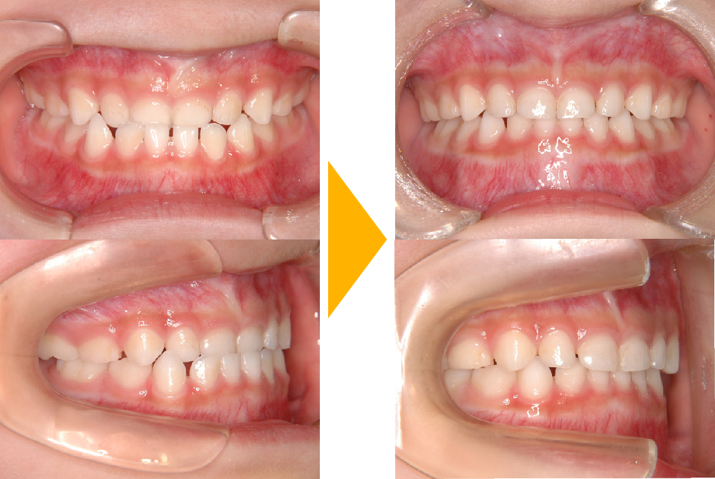 症例1：歯性反対咬合(受け口)の改善
