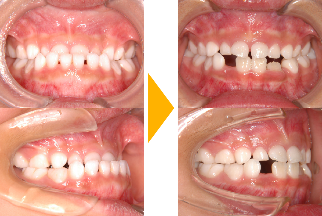 症例2：骨格性反対咬合(受け口)の改善