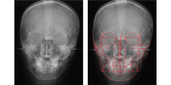 頭部X線規格写真(正貌)