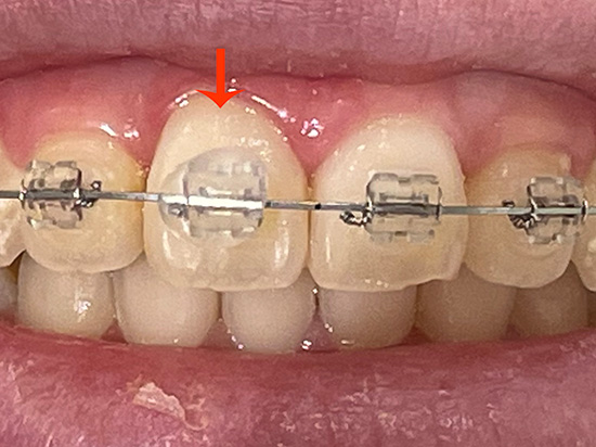 ②ブラケットがあたる箇所に口内炎ができて痛い