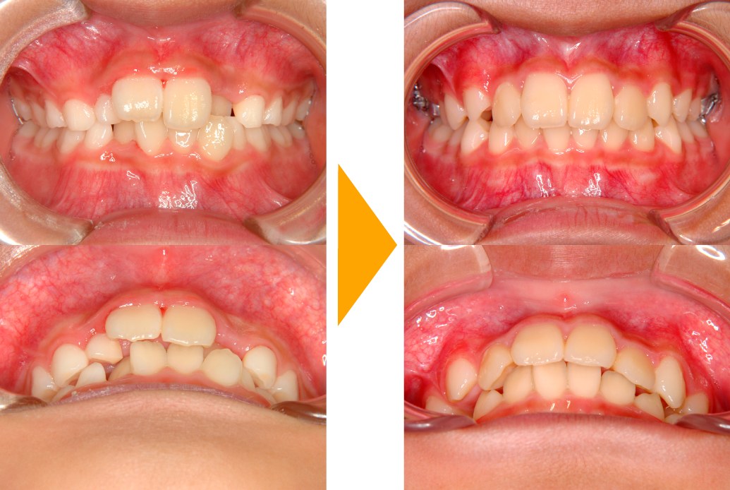 ガタガタ歯並び（軽度～中等度）の改善