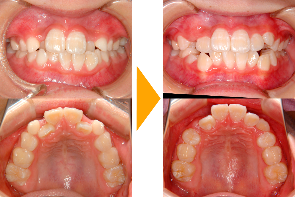 交叉咬合の改善