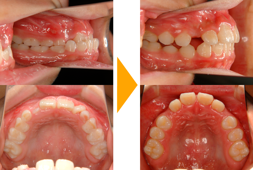 交叉咬合の改善