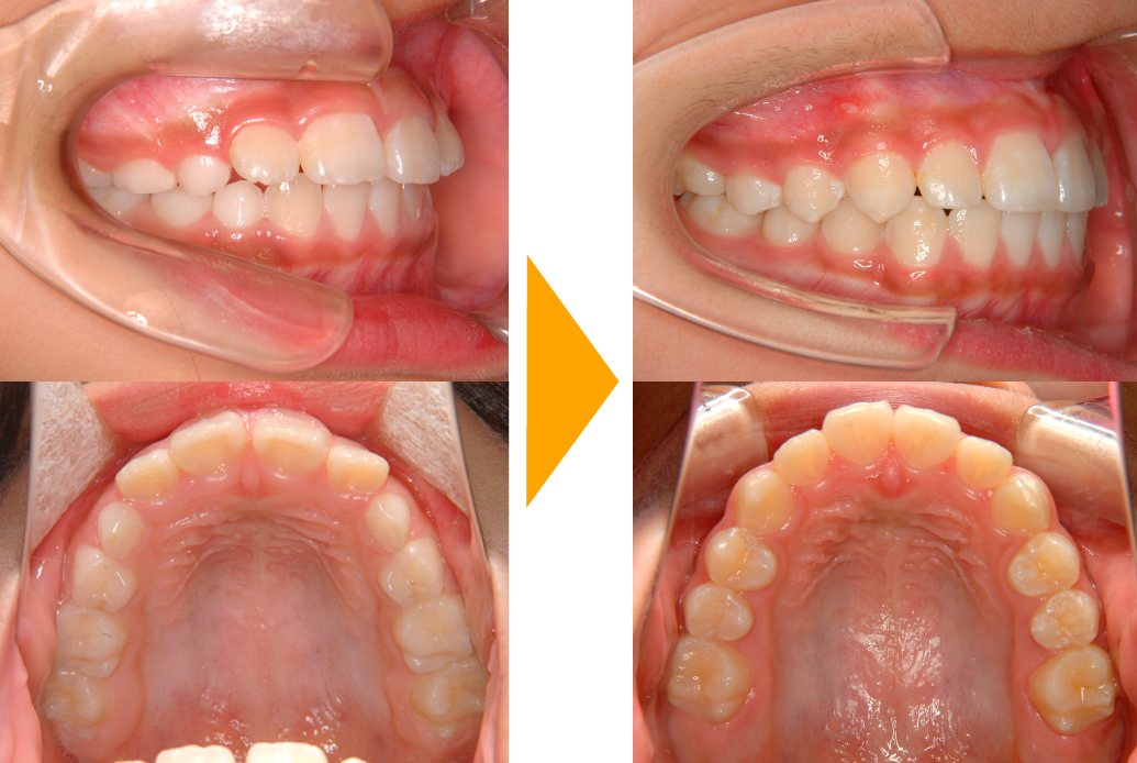 交叉咬合の改善
