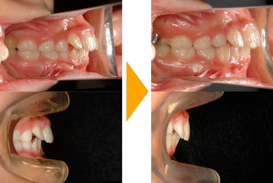 交叉咬合の改善
