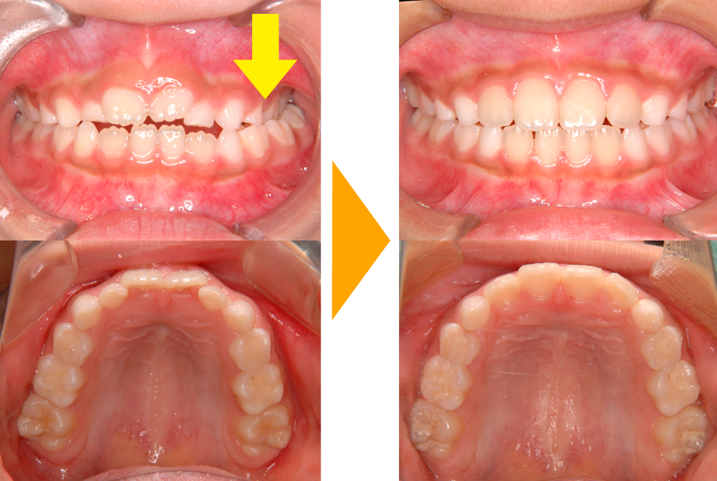 交叉咬合の改善