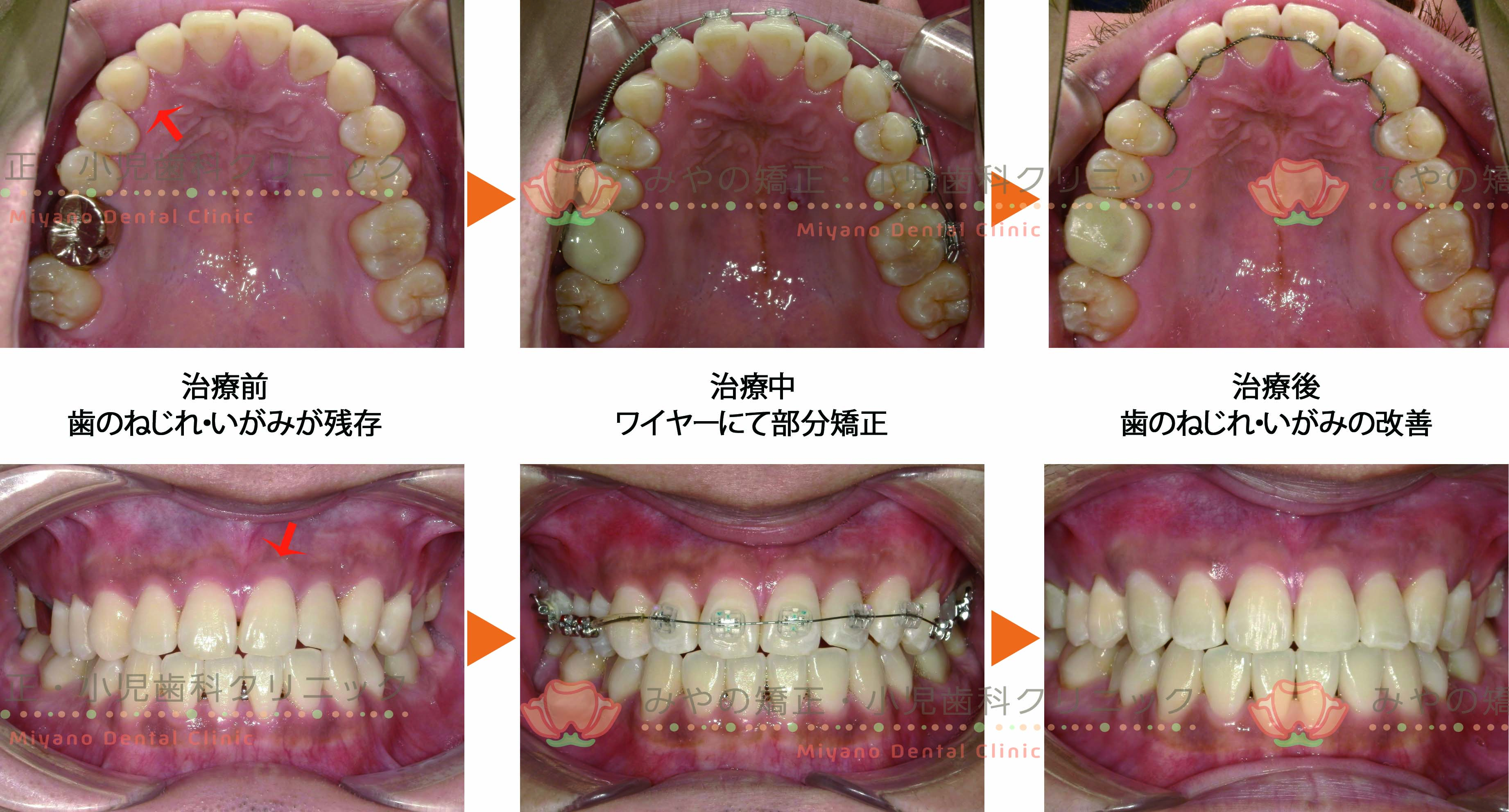 ワイヤーの部分矯正にて対応した症例