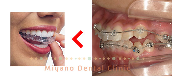 マウスピース矯正 ＜ ワイヤー矯正
