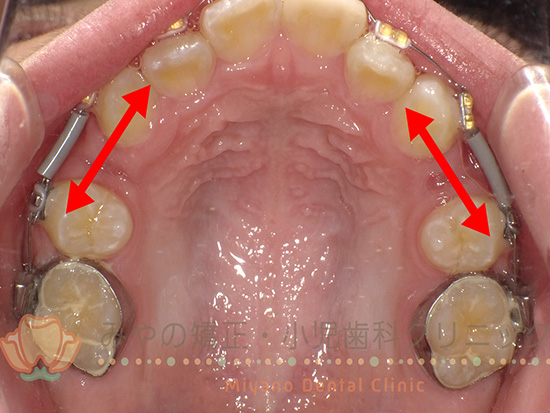 インビザラインの歯の動きの特徴
