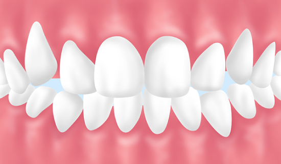 八重歯・ガタガタ歯並び(叢生)