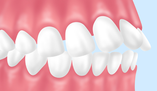 出っ歯(上顎前突)