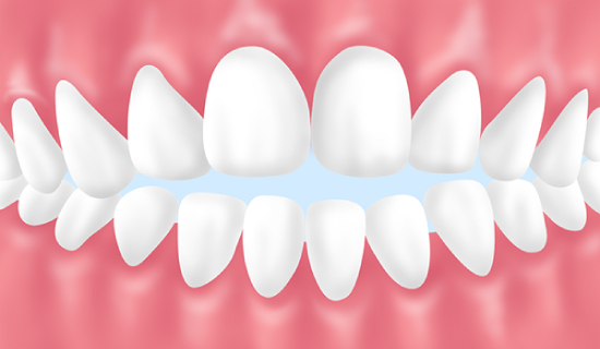 前歯で咬めない(開咬)