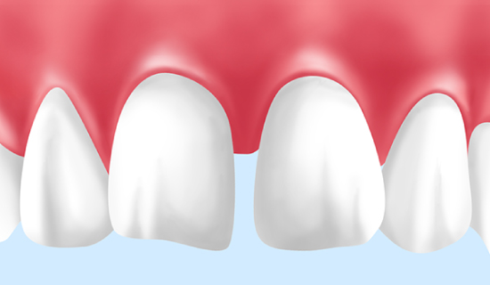 すきっ歯(正中離開)