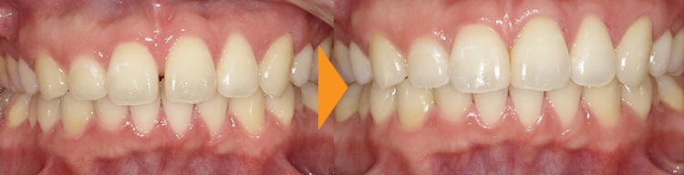 すきっ歯(正中離開)の改善