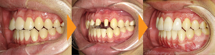 出っ歯(上顎前突)・開咬の改善