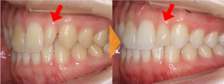 すきっ歯(小さい歯・矮小歯)の改善