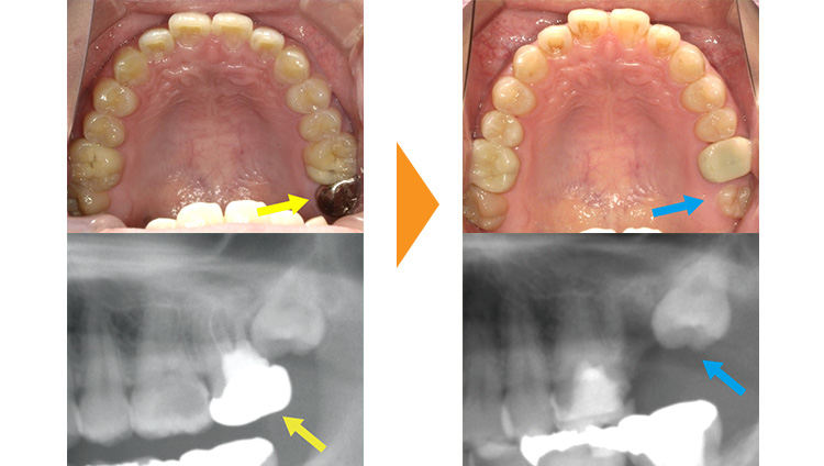 12歳臼歯の抜歯・親知らずの使用