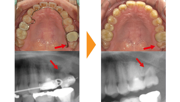 歯のガタガタ改善（再治療・マウスピース矯正→ワイヤー矯正）