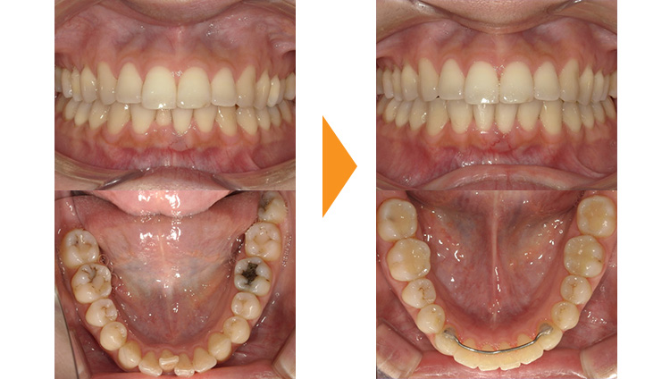 すきっぱ（正中離開）の矯正治療