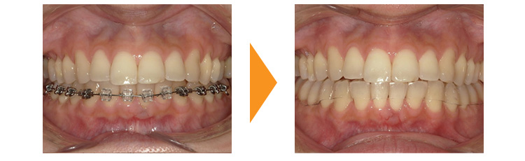 歯のガタガタ改善（再治療・マウスピース矯正→ワイヤー矯正）