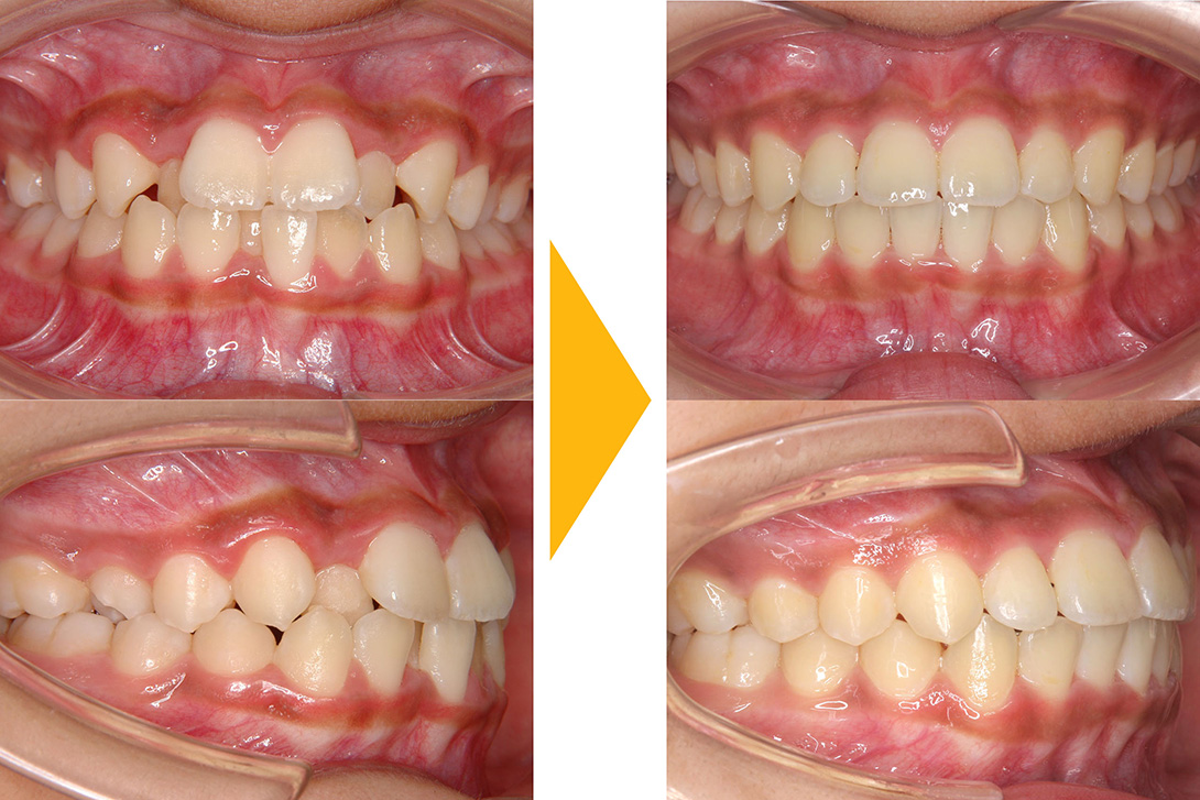 症例1：非抜歯矯正(叢生)