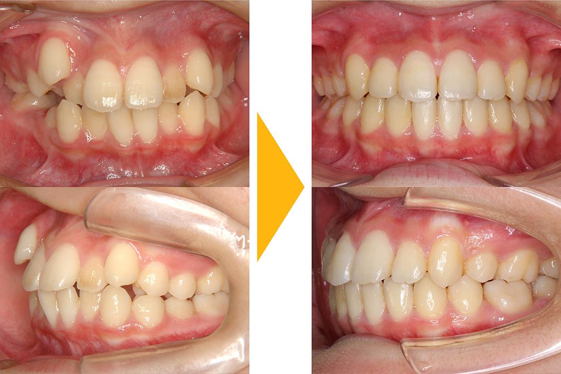 症例2：抜歯矯正(叢生)